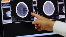 Huntington hastalığı nedir? Huntington hastalığı belirtileri
