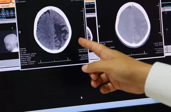 Huntington hastalığı nedir? Huntington hastalığı belirtileri
